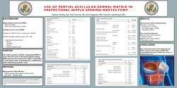 Thumbnail for Outcomes Of Partial Acellular Dermal Matrix Use In Prepectoral Nipple-sparing Mastectomies