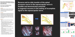 Thumbnail for Reverse End-to-side Spinal Accessory To Suprascapular Supercharge Nerve Transfer For Brachial Plexus Birth Injury