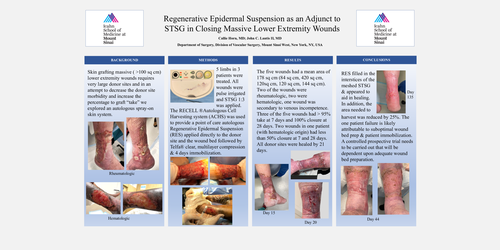 Preview of Regenerative Epidermal Suspension As An Adjunct To STSG In Closing Massive Lower Extremity Wounds.