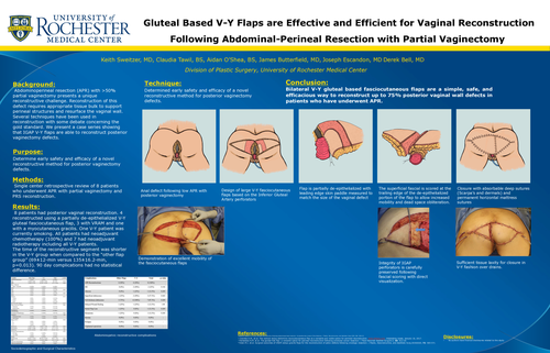 Preview of Gluteal Based V-Y Flaps Are Effective And Efficient For Vaginal Reconstruction Following Abdominal-perineal Resection With Partial Vaginectomy
