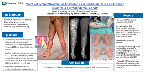 Preview of Effects Of Lymphaticovenular Anastomosis In Contralateral Leg In Patients With Acquired Bilateral Leg Lymphedema