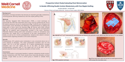 Preview of Prospective Cohort Study Evaluating Chest Reinnervation In Gender Affirming Double Incision Mastectomy With Free Nipple Grafting