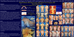 Thumbnail for Total Breast Reconstruction With Autologous Fat Transfer (aft) And Reverse Expansion (er): Experience With 2000 Aft-er Breasts