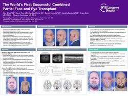 Thumbnail for The World’s First Successful Combined Face And Whole Eye Transplant