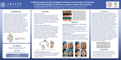 Thumbnail for A Reinforced Auricular Cartilage Framework Construction Technique In Asian Rhinoplasty To Prevent Long-term Nasal Tip Drooping