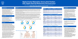 Thumbnail for Nipple Areolar Malposition Versus Ideal Position After Nipple-Sparing Mastectomy Reconstruction