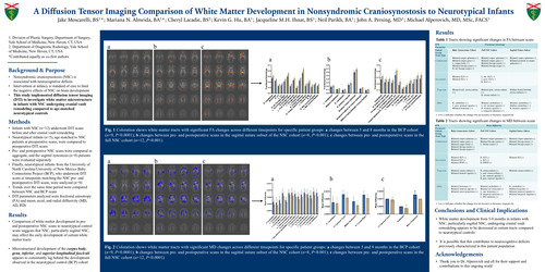 Preview of A Diffusion Tensor Imaging Comparison Of White Matter Development In Nonsyndromic Craniosynostosis To Neurotypical Infants