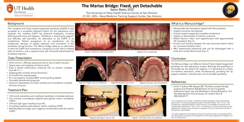 Preview of The Marius Bridge: Fixed, yet Detachable