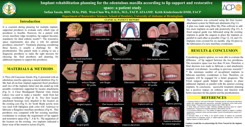 Preview of Implant rehabilitation planning for edentulous maxilla according to lip support and restorative space: a case report.