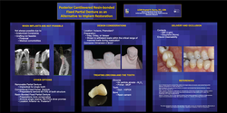 Thumbnail for Posterior cantilevered resin-bonded fixed partial denture as an alternative to implant restoration
