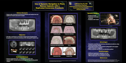 Thumbnail for Placement of Rescue Implants with Dynamic Navigation Using a Duplicated Conversion Prosthesis