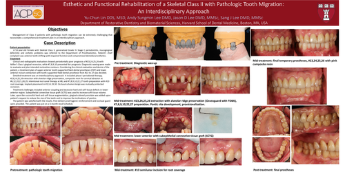 Preview of Esthetic and functional rehabilitation of a Skeletal class II with pathologic tooth migration: an interdisciplinary approach