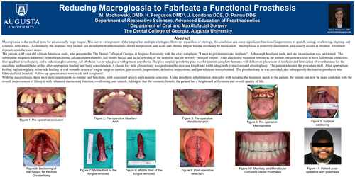 Preview of Reducing Macroglossia to Fabricate a Functional Prosthesis