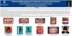 Thumbnail for Reducing Macroglossia to Fabricate a Functional Prosthesis