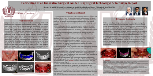 Preview of Fabrication of a floating implant and bone surgical guide using digital technology: A technique article