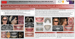 Thumbnail for Full mouth Fixed Implant Rehabilitation of a partially edentulous patient with vertical maxillary excess 