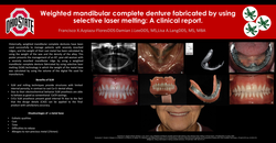 Thumbnail for Weighted mandibular complete denture fabricated using selective laser melting: A clinical report.