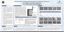 Thumbnail for Bond Strength of Orthodontic Brackets to Temporary Crowns: In Vitro Effects of Surface Treatment