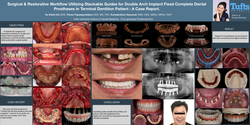Thumbnail for Surgical &amp; Restorative Workflow Utilizing Stackable Guides for Double Arch Implant Fixed Complete Dental Prostheses in Terminal Dentition Patient: A Case Report. 