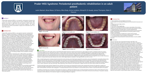 Preview of Prader-Willi Syndrome: Periodontal-Prosthodontic Rehabilitation in an Adult Patient