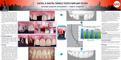 Thumbnail for CATER; A DIGITAL SINGLE TOOTH IMPLANT STUDY