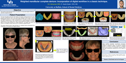 Thumbnail for Weighted mandibular complete denture: Incorporation of digital workflow in a classic technique.