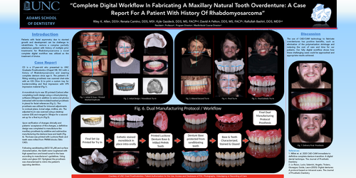 Preview of “Complete Digital Workflow in Fabricating Maxillary Tooth-borne Overdenture: A Case Report for a Patient with History of Rhabdomyosarcoma”