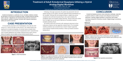 Thumbnail for Treatment of Adult Ectodermal Dysplasia Utilizing a Hybrid Digital Workflow