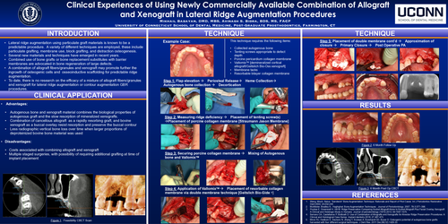 Preview of Clinical experiences of using newly commercially available combination of allograft and xenograft in lateral ridge augmentation procedures