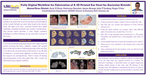 Preview of Fully digital workflow for fabrication of a 3D-printed ear stent for Auricular Keloid: