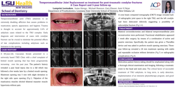 Thumbnail for Temporomandibular Joint Replacement as treatment for post-traumatic condylar fractures 
<p>A Case Report and 3 year Follow-up</p>