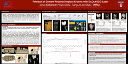 Thumbnail for Retrieval of cement-retained implant crowns with Er, Cr:YSGG laser.