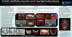 Thumbnail for Prosthetic Rehabilitation Of Gunshot Wound Using Digital Implant Planning