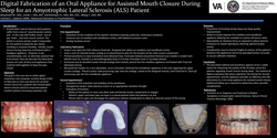 Thumbnail for Digital Fabrication of an Oral Appliance for Assisted Mouth Closure During Sleep for an Amyotrophic Lateral Sclerosis (ALS) Patient