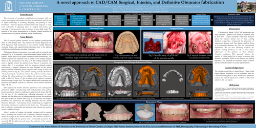 Preview of A Novel approach to fabricating Surgical, Interim and Definitive obturator fabrication