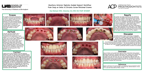 Preview of Maxillary Anterior Digitally Guided Implant Workflow – From Snap on Smile to Zirconia Screw Retained Crowns