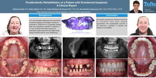 Preview of Prosthodontic Rehabilitation of a Patient with Ectodermal Dysplasia: A clinical report