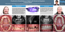 Thumbnail for Prosthodontic Rehabilitation of a Patient with Ectodermal Dysplasia: A clinical report