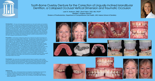Preview of Tooth-Bourne Overlay Denture for the Correction of Lingually Inclined Mandibular Dentition, a Collapsed Occlusal Vertical Dimension and Traumatic Occlusion