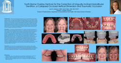 Thumbnail for Tooth-Bourne Overlay Denture for the Correction of Lingually Inclined Mandibular Dentition, a Collapsed Occlusal Vertical Dimension and Traumatic Occlusion