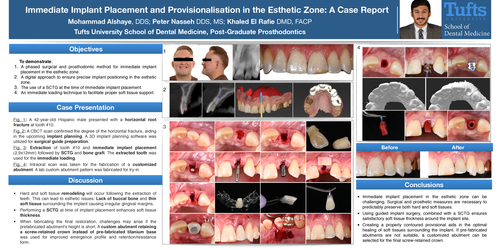 Preview of Immediate implant placement in the anterior esthetic zone