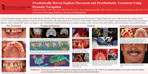Preview of Prosthetically driven implant placement and prosthodontic treatment using dynamic navigation