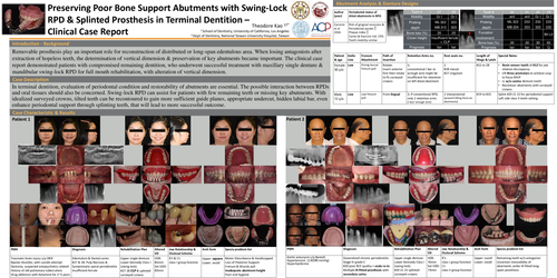 Preview of Preserving Poor Bone Support Abutments with Swing-Lock RPD and Splinted Fixed Prosthesis in Terminal Dentition – Clinical Case Report