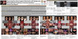 Thumbnail for Preserving Poor Bone Support Abutments with Swing-Lock RPD and Splinted Fixed Prosthesis in Terminal Dentition – Clinical Case Report