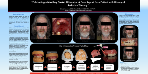 Preview of “Fabricating a Maxillary Gasket Obturator: A Case Report for a Patient with History of Radiation Therapy"