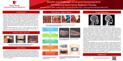 Thumbnail for Benefits and Challenges of Intraoral Positioning Stent for Head and Neck Cancer Radiation Therapy