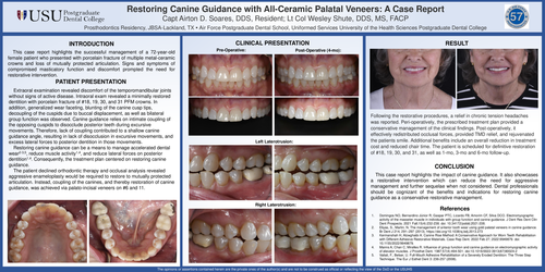 Preview of Restoring Canine Guidance with All-Ceramic Palatal Veneers: A Case Report