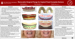 Thumbnail for Gingival mask for fixed complete denture