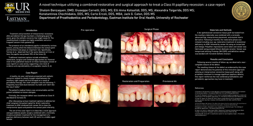 Preview of A novel technique utilizing a combined restorative and surgical approach to treat a Class III papillary recession: a case report