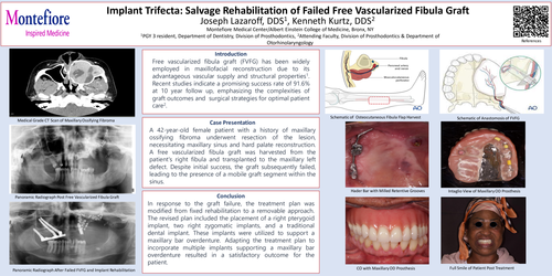 Preview of Implant Trifecta: Salvaged Rehabilitation of Failed Free Vascularized Fibula Graft